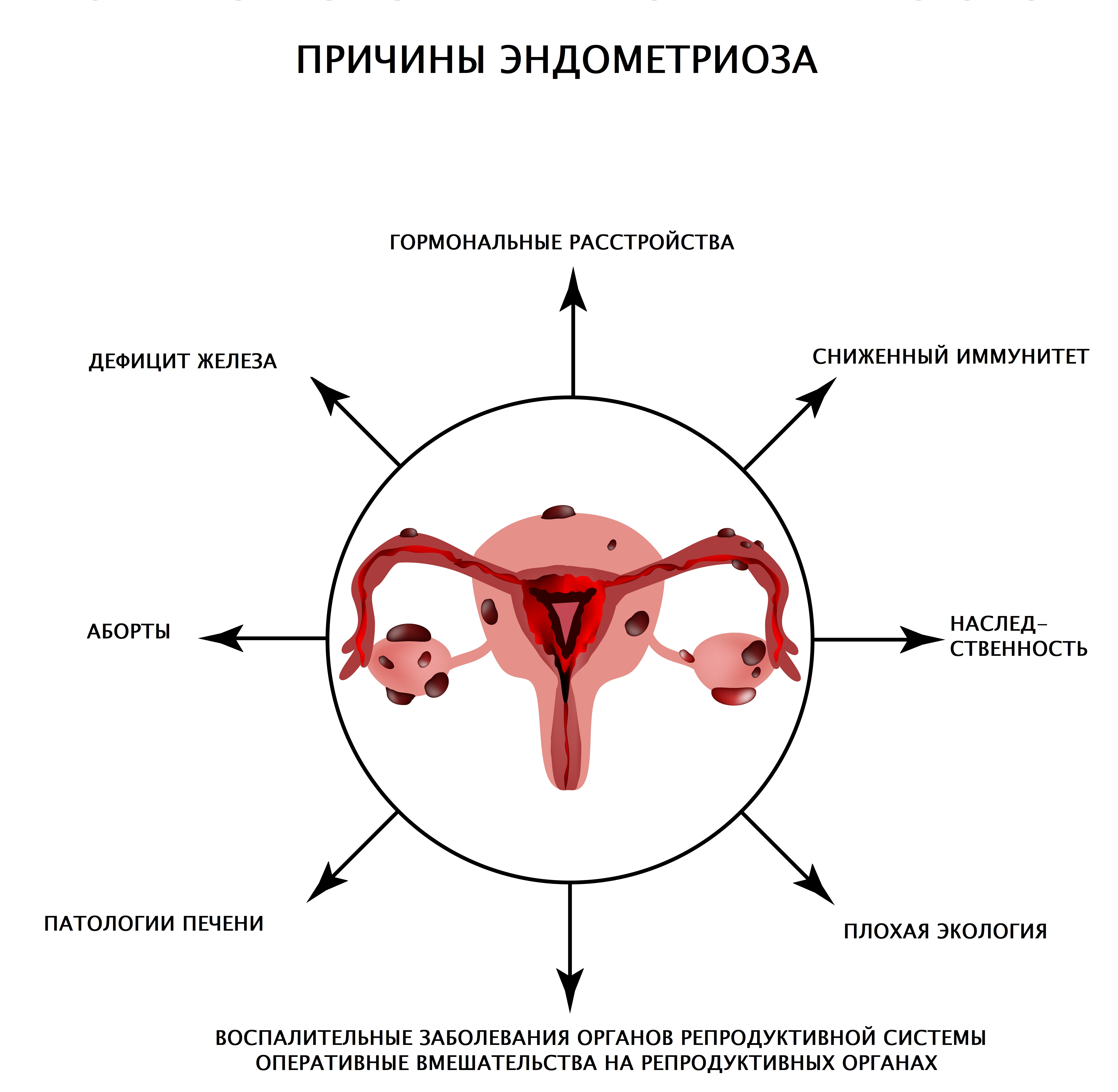 Лечение эндометриоза